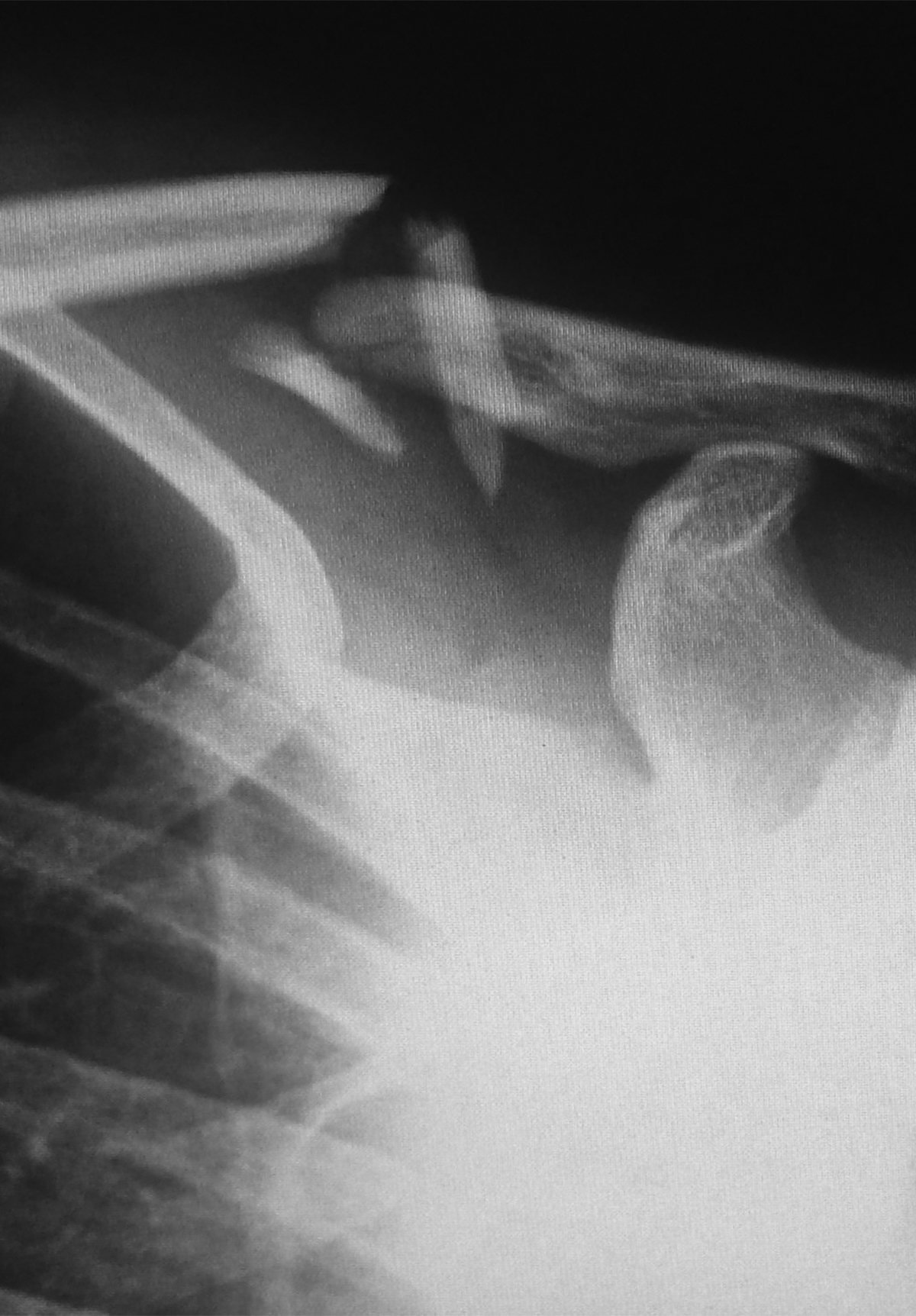 shoulder-and-upperlimb-x-ray